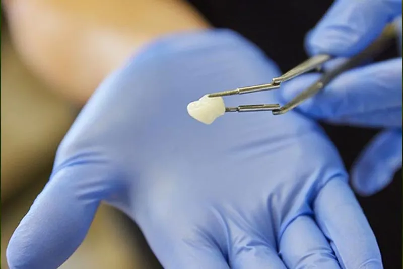 cerec crown being looked at by dentist