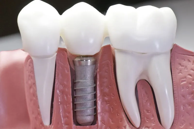 a dental implant model jaw bone cutaway showing the implant post.