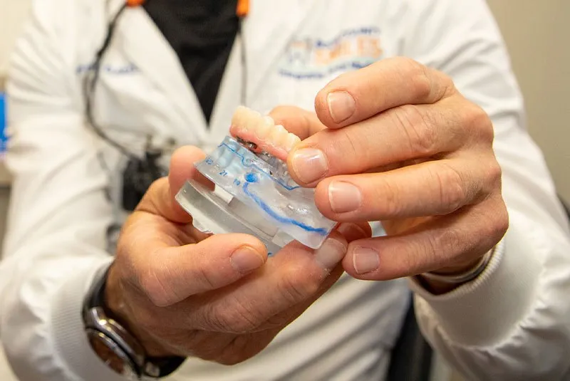 full arch dental implants model