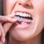 Woman with perfect smile inserting invisible dental aligners for dental correction