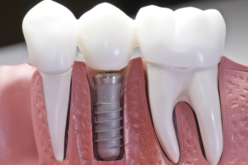 Unsure If You Are A Candidate For Tooth Implants In Yardley, PA? We Can Help You Find Out