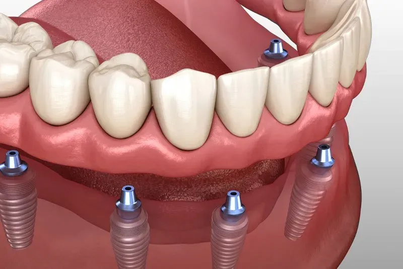 a 3D model of implant supported dentures.