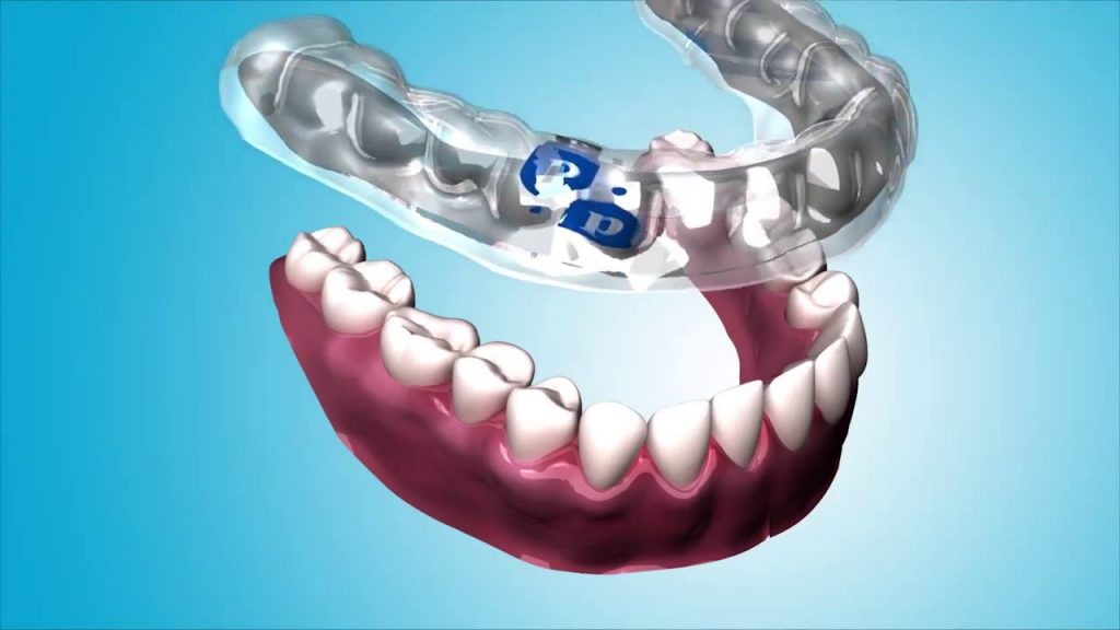 5 Benefits of Using PerioProtect to Treat Gum Disease
