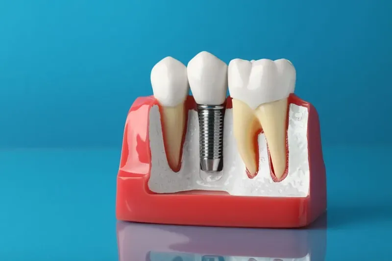 blue background; a dental implant model on reflective glass.