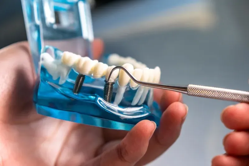 close-up of a dental implant model being held by a hand. The model shows a clear plastic jaw with a set of white teeth. One of the teeth has a metal dental implant installed in it, and a tool, likely a dental explorer or probe, is being used to point at or manipulate the implant.
