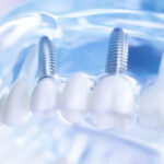 A dental model displaying prosthetic teeth, gums, and titanium screw implants, used for teaching and demonstrating dental implant procedures.