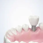 A close-up of a dental implant model showing a white tooth and pink gums illustrates the integration of a dental implant into the jaw for medical education.