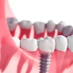 Close-up of a dental implant integrated into the lower jaw, illustrating the implant's placement and its realistic appearance alongside natural teeth.